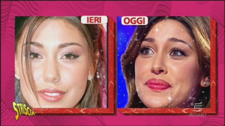 Belen prima e dopo chirurgia