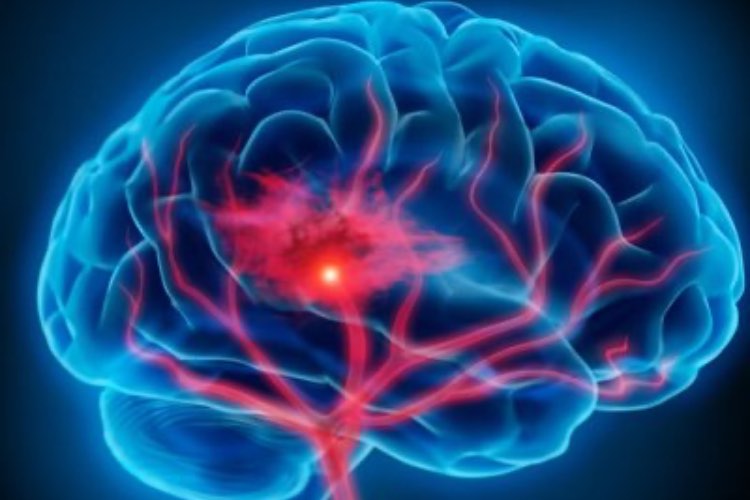 Ictus, tanta gente è a rischio e non lo sa: ecco i trucchi per salvarsi la vita Ictus, tanta gente è a rischio e non lo sa: ecco i trucchi per salvarsi la vita